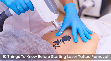 10 Things To Know Before Starting Laser Tattoo Removal 