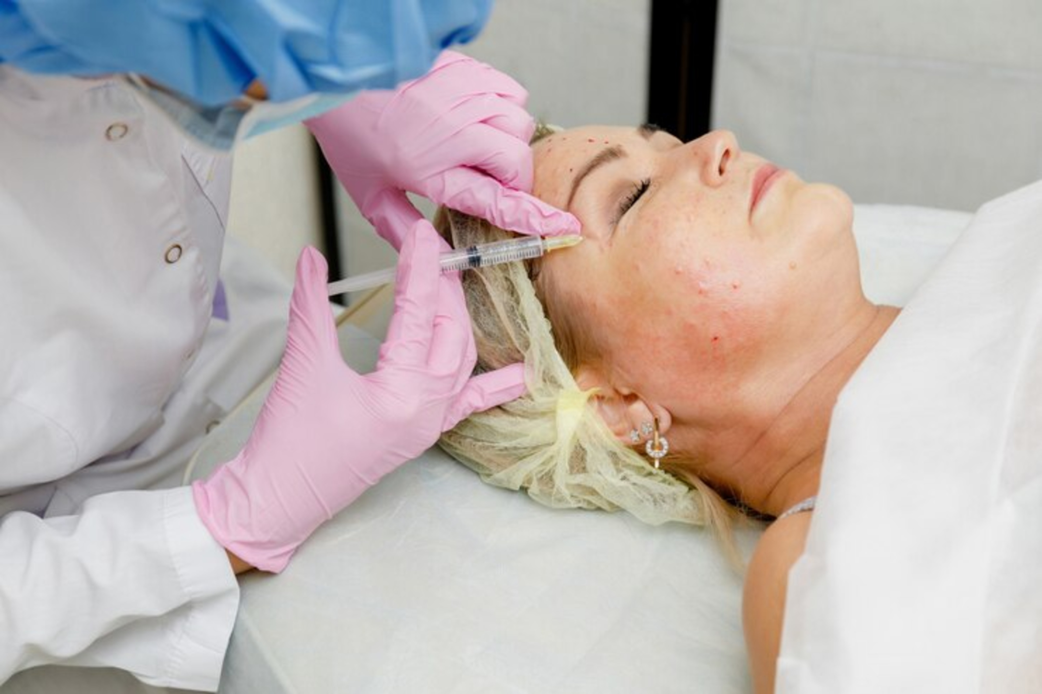 How to Care for Your Skin After a Deep Chemical Peel