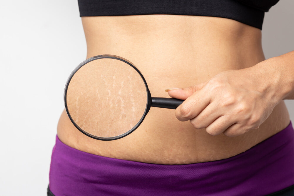 Strive for Striae-Free Skin: Unveiling the Secrets of Stretch Marks, Causes, and Top-Tier Treatments