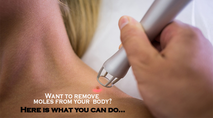 How Does Laser Treatment Help Remove Moles From the Body? 