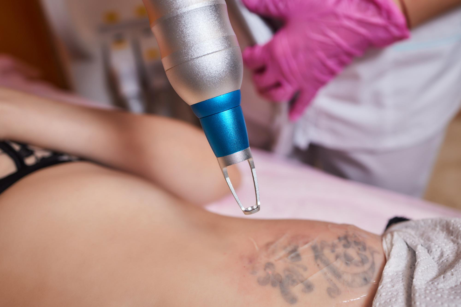 Did you know that 92% of the population has contemplated getting a tattoo removed? Are you seeking tattoo removal? 
