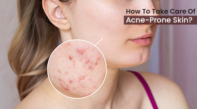 How To Take Care Of Acne-Prone Skin? 